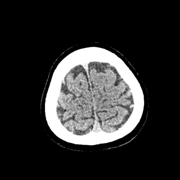 Cerebral ring enhancing lesions - cerebral metastases (Radiopaedia 44922-48818 Axial non-contrast 83).jpg
