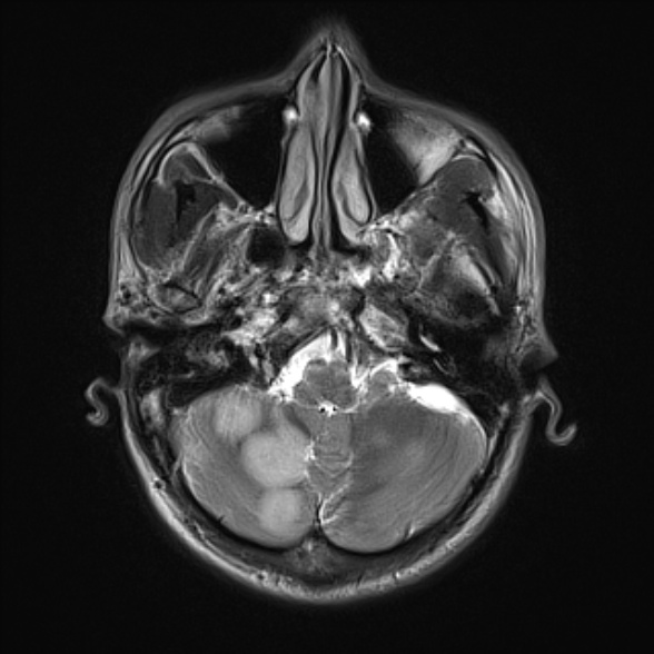 File:Cerebral toxoplasmosis (Radiopaedia 53993-60132 Axial T2 5).jpg