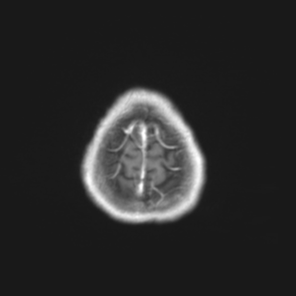 File:Cerebral toxoplasmosis (Radiopaedia 53993-61435 Axial T1 24).jpg