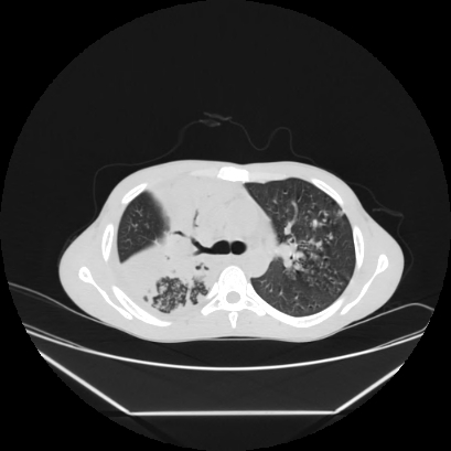 Cerebral tuberculoma (Radiopaedia 80829-94318 Axial lung window 60).jpg