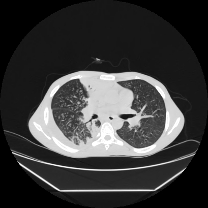 Cerebral tuberculoma (Radiopaedia 80829-94318 Axial lung window 79).jpg