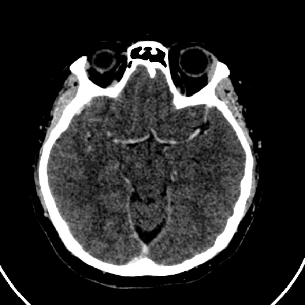 File:Cerebral venous hemorrhagic infarct from venous sinus thrombosis (Radiopaedia 55433-61883 Axial C+ delayed 91).jpg