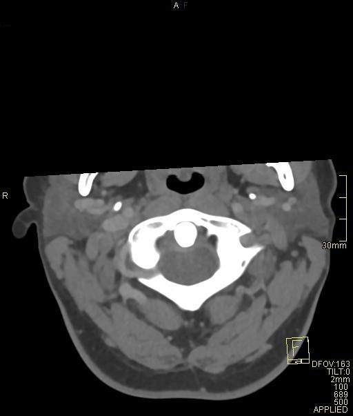 Cerebral venous sinus thrombosis (Radiopaedia 91329-108965 Axial venogram 5).jpg