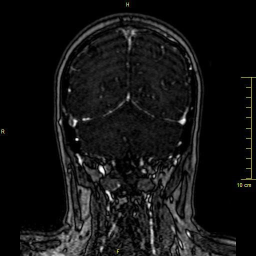 Cerebral venous thrombosis (Radiopaedia 23288-23351 MRV 127).JPG