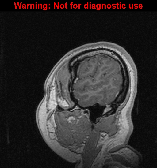 Cerebral venous thrombosis (Radiopaedia 37224-39208 Sagittal T1 C+ 135).jpg