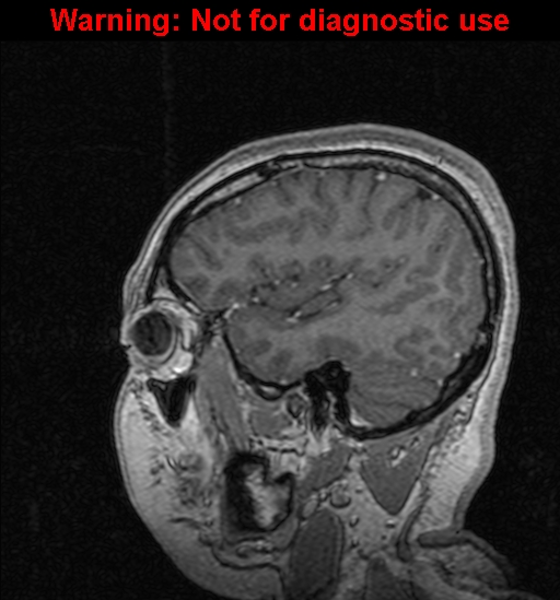 File:Cerebral venous thrombosis (Radiopaedia 37224-39208 Sagittal T1 C+ 36).jpg
