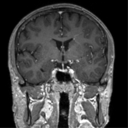 Cerebral venous thrombosis (Radiopaedia 38392-40469 Coronal T1 C+ 51).png