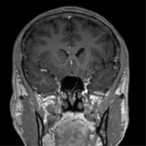 Cerebral venous thrombosis (Radiopaedia 38392-40469 Coronal T1 C+ 60).png