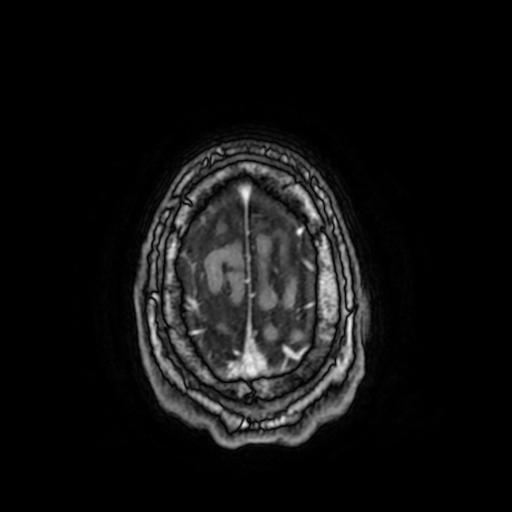 File:Cerebral venous thrombosis with secondary intracranial hypertension (Radiopaedia 89842-106957 Axial T1 C+ 154).jpg