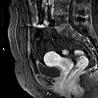 File:Cervical adenocarcinoma (Radiopaedia 65011-73985 E 19).jpg