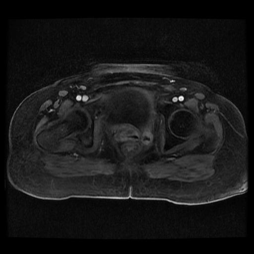 File:Cervical carcinoma (Radiopaedia 70924-81132 Axial T1 C+ fat sat 37).jpg