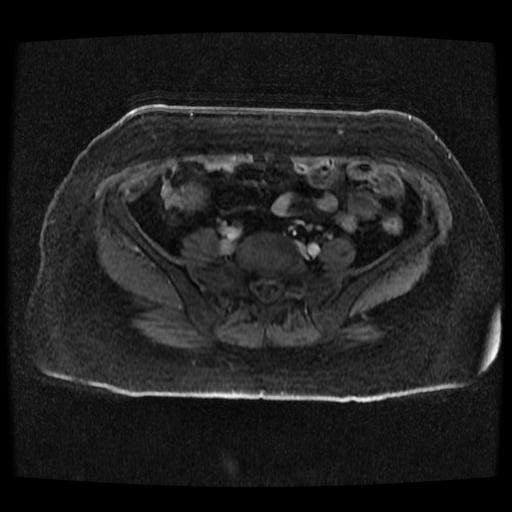 Cervical carcinoma (Radiopaedia 70924-81132 Axial T1 C+ fat sat 78).jpg