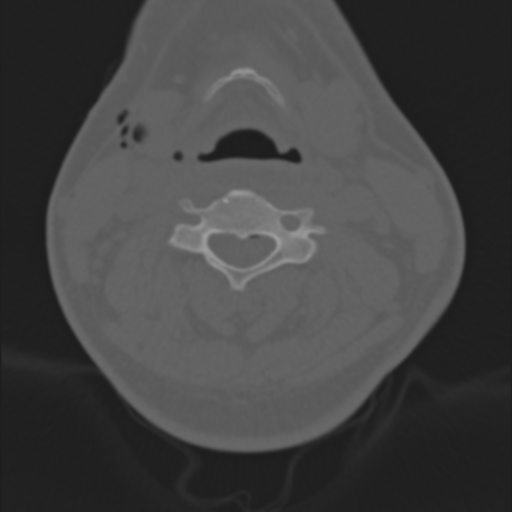 File:Cervical disc replacement (Radiopaedia 44025-47541 Coronal bone window 1).png