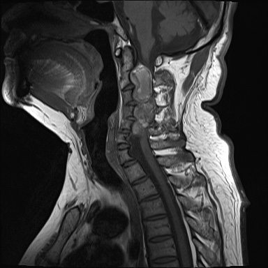 File:Cervical spinal neurofibroma in a patient with NF1 (Radiopaedia 58344-65465 Sagittal T1 6).jpg