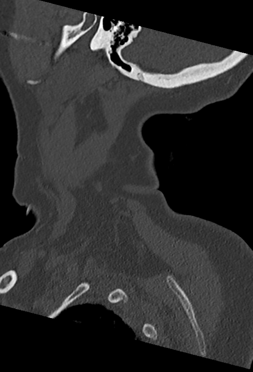 Cervical spine ACDF loosening (Radiopaedia 48998-54070 Sagittal bone window 12).png