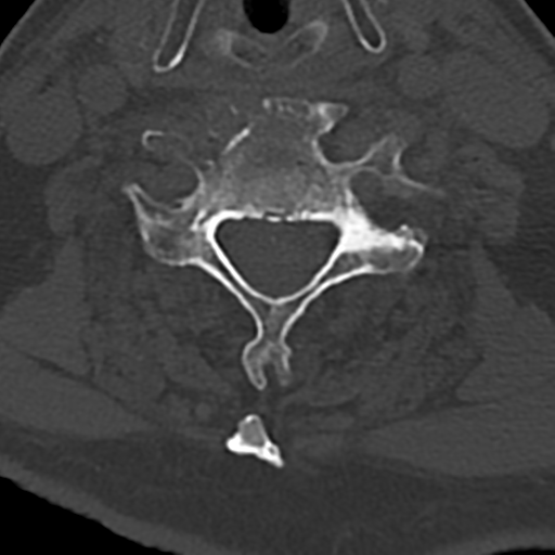 File:Cervical spine fracture - chalk stick (Radiopaedia 39116-41323 Axial bone window 62).png