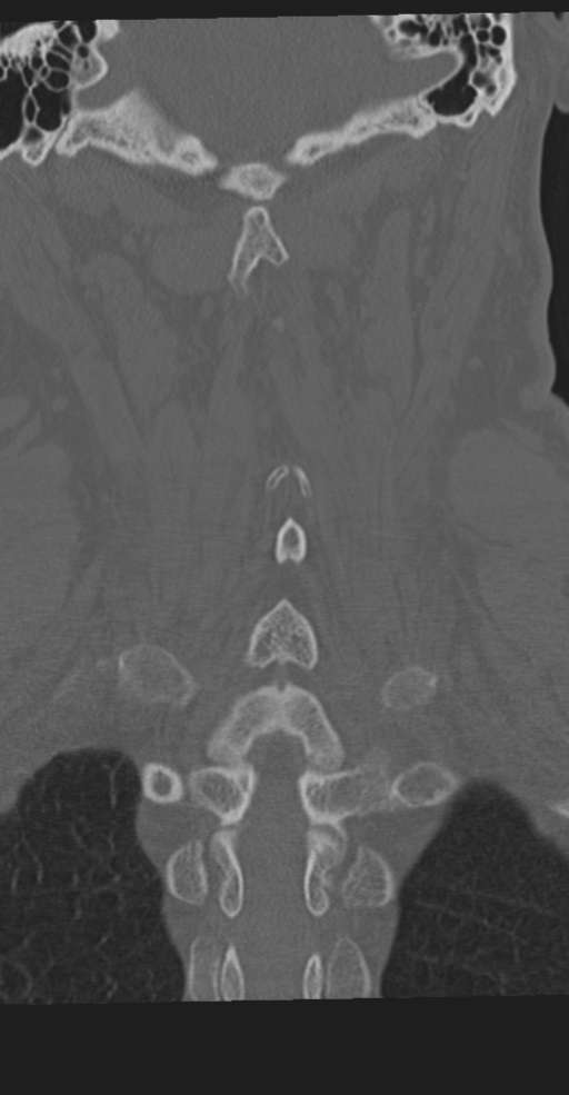 Cervical spine fracture in the setting of ankylosis (Radiopaedia 37038-38715 Coronal bone window 51).png