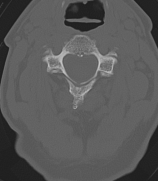 File:Cervical spine fractures with vertebral artery dissection (Radiopaedia 53296-59268 Axial bone window 23).png