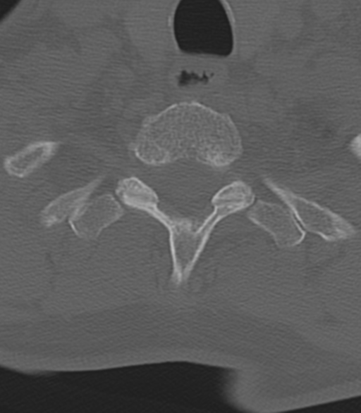 File:Cervical spine fractures with vertebral artery dissection (Radiopaedia 53296-59268 Axial bone window 50).png