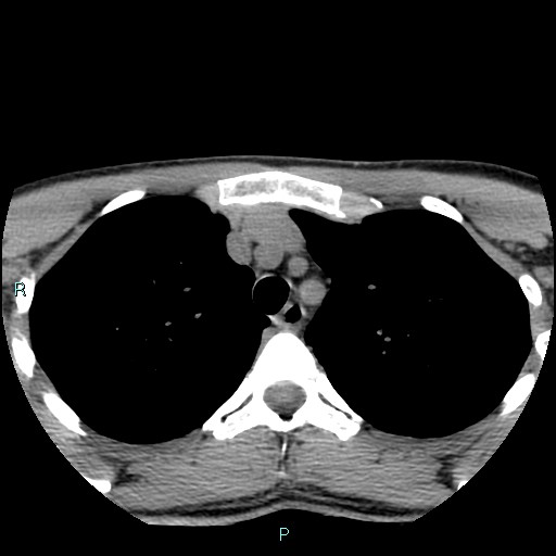 Cervical thymic cyst (Radiopaedia 88632-105335 Axial non-contrast 6).jpg
