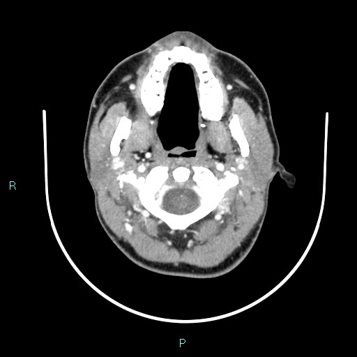 Cervical thymic cyst (Radiopaedia 88632-105335 B 93).jpg