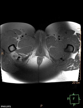 File:Cesarian scar endometriosis (Radiopaedia 68495-78066 Axial T1 fat sat 29).jpg