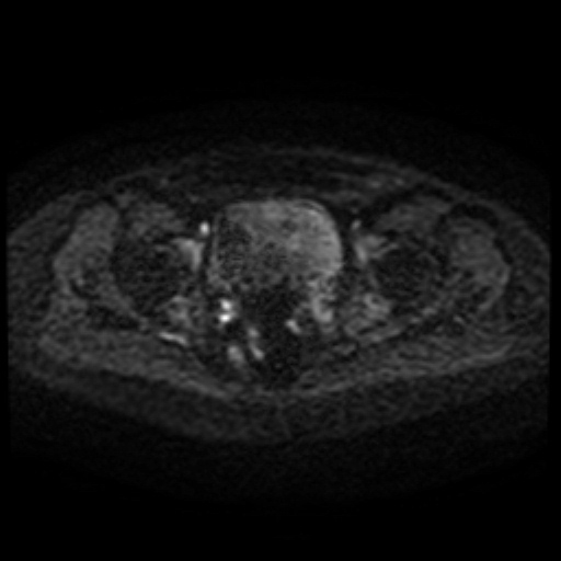 Cesarian section scar endometriosis (Radiopaedia 66520-75799 Axial DWI 68).jpg