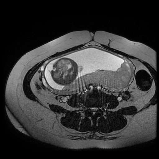 Chiari II malformation - fetal MRI (Radiopaedia 68099-77581 Axial Fiesta 15).jpg