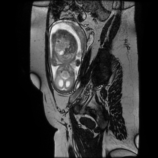 File:Chiari II malformation - fetal MRI (Radiopaedia 68099-77581 Sagittal Fiesta 15).jpg