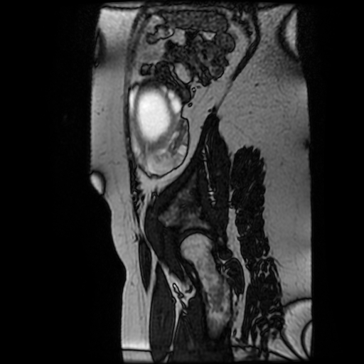 Chiari II malformation - fetal MRI (Radiopaedia 68099-77581 Sagittal Fiesta 5).jpg
