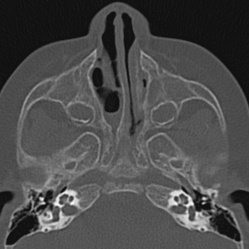 Choanal atresia (Radiopaedia 88525-105975 Axial bone window 33).jpg