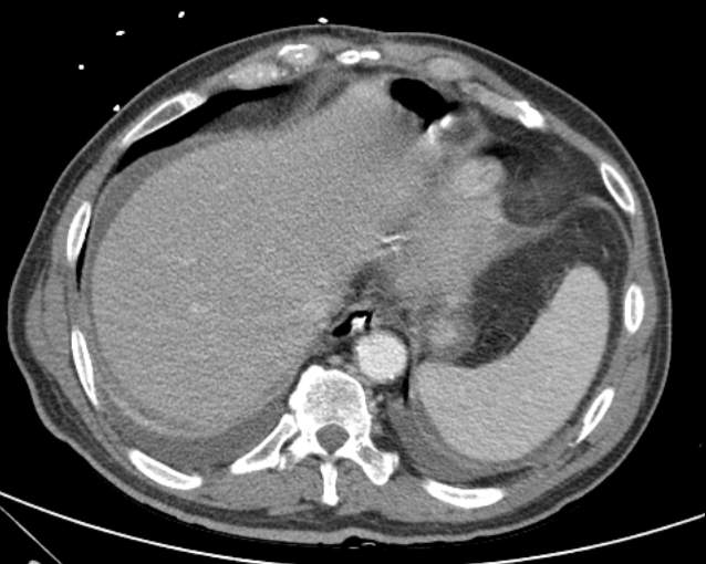 File:Cholecystitis - perforated gallbladder (Radiopaedia 57038-63916 A 14).jpg