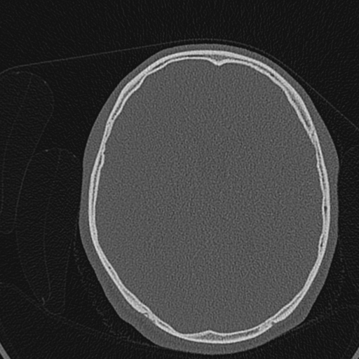 Cholesteatoma (Radiopaedia 70429-80529 Axial bone window 170).jpg