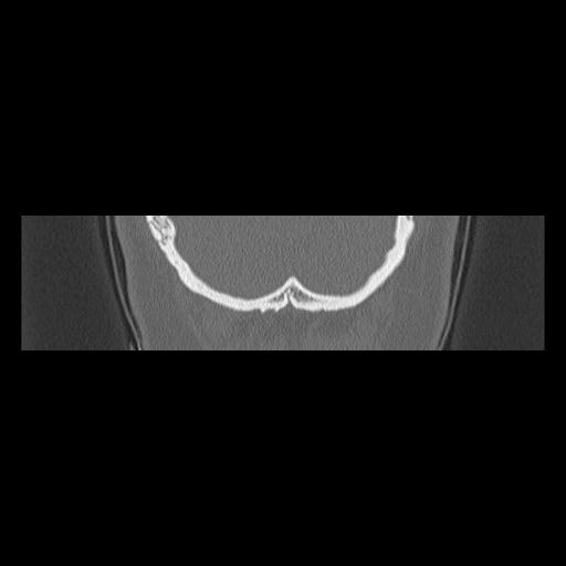 File:Cholesteatoma (Radiopaedia 84946-100455 Coronal bone window 153).jpg