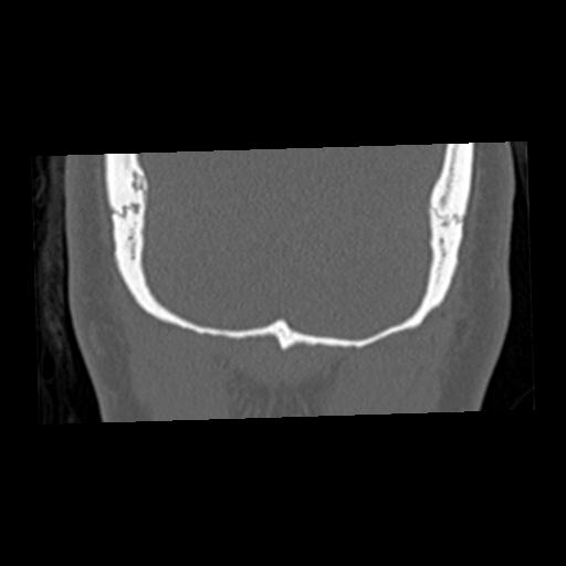 Cholesteatoma (Radiopaedia 84960-100474 Coronal bone window 81).jpg