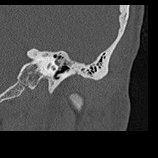 File:Cholesteatoma of the external ear (Radiopaedia 16540-16225 Coronal bone window 6).jpg