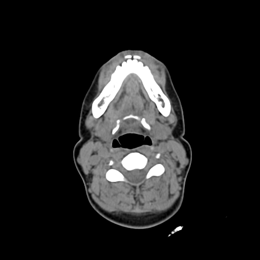 File:Chondroblastic osteosarcoma (Radiopaedia 67363-76741 Axial non-contrast 19).jpg