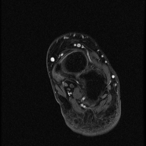 File:Chondroblastoma - midfoot (Radiopaedia 64831-73765 G 7).jpg
