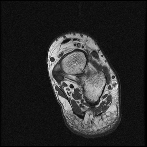 File:Chondroblastoma - midfoot (Radiopaedia 64831-73765 Short axis T1 6).jpg