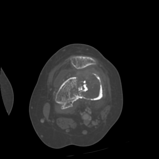 Chondrosarcoma - femur (Radiopaedia 64187-72954 Axial bone window 32).jpg