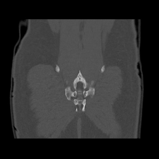 Chondrosarcoma of iliac wing (Radiopaedia 63861-72599 Coronal bone window 102).jpg