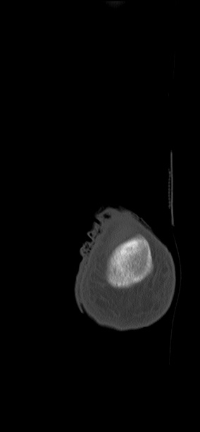 Chopart fracture (Radiopaedia 35347-36851 Coronal bone window 3).jpg