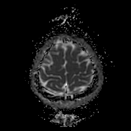 File:Chordoid glioma of third ventricle (Radiopaedia 91612-109340 Axial ADC 25).jpg