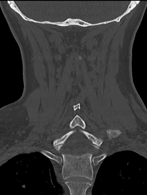Chordoma (C4 vertebra) (Radiopaedia 47561-52188 Coronal bone window 42).png