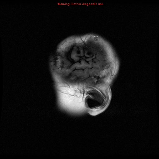 File:Choroid plexus carcinoma - recurrent (Radiopaedia 8330-9169 Sagittal T1 19).jpg