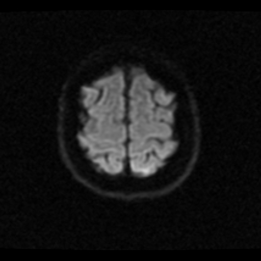 File:Choroid plexus xanthogranuloma (Radiopaedia 17650-17386 DWI 3).jpg