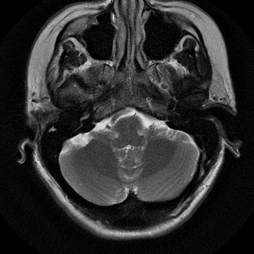File:Choroid plexus xanthogranuloma (Radiopaedia 17650-17386 T2 20).jpg