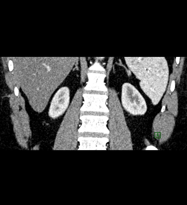 Chromophobe renal cell carcinoma (Radiopaedia 84286-99573 E 66).jpg