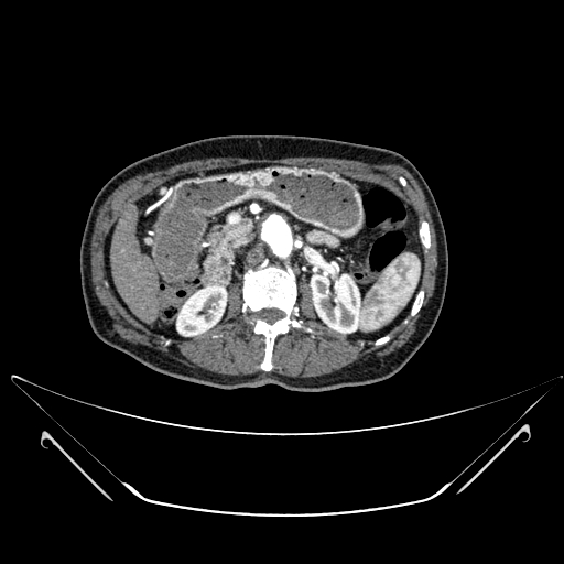 Chronic contained rupture of abdominal aortic aneurysm with extensive erosion of the vertebral bodies (Radiopaedia 55450-61901 A 18).jpg