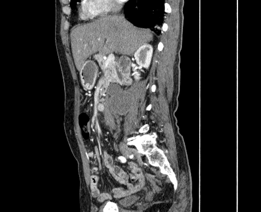 Chronic contained rupture of abdominal aortic aneurysm with extensive erosion of the vertebral bodies (Radiopaedia 55450-61901 B 12).jpg